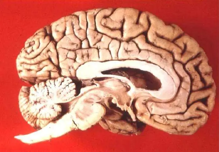 Brain Donation: Opt-in or Opt-out?